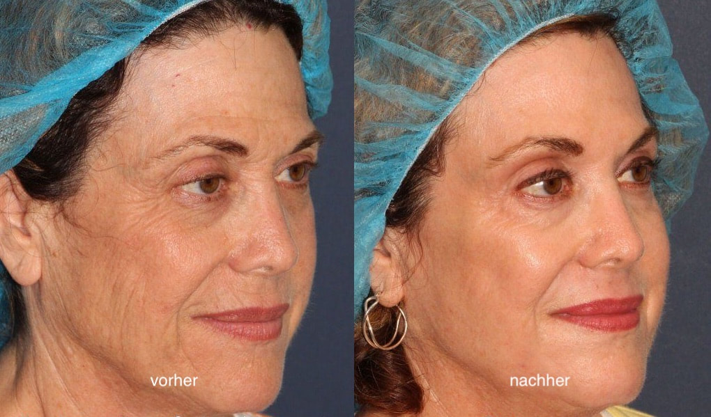 Laserbehandlung Gesicht Pigmentflecken